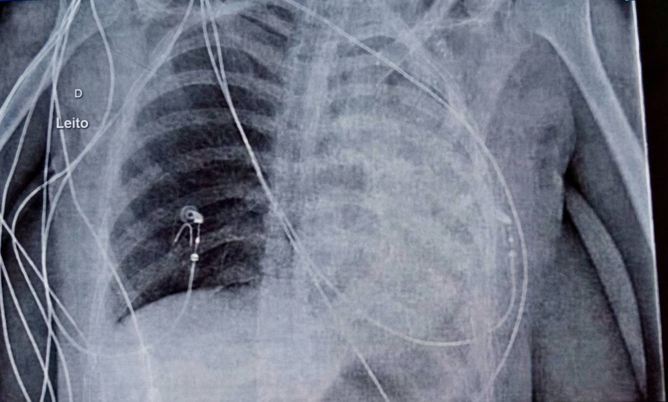 Imagem da questão de Suporte Ventilatório