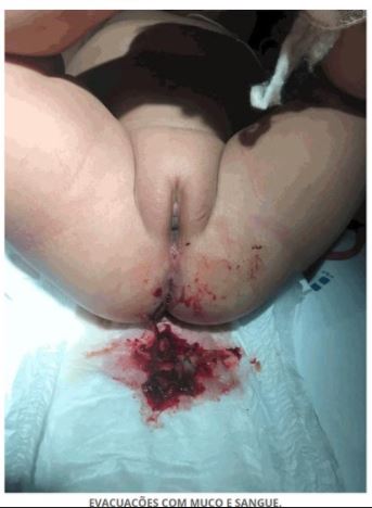 Imagem da questão de Emergências Cirúrgicas na Infância