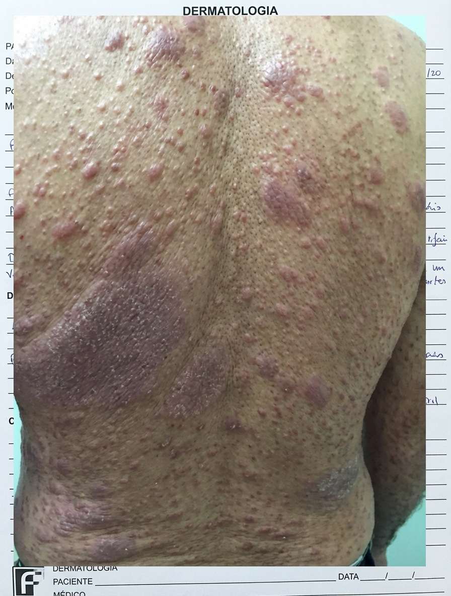Imagem da questão de Infecções Cutâneas