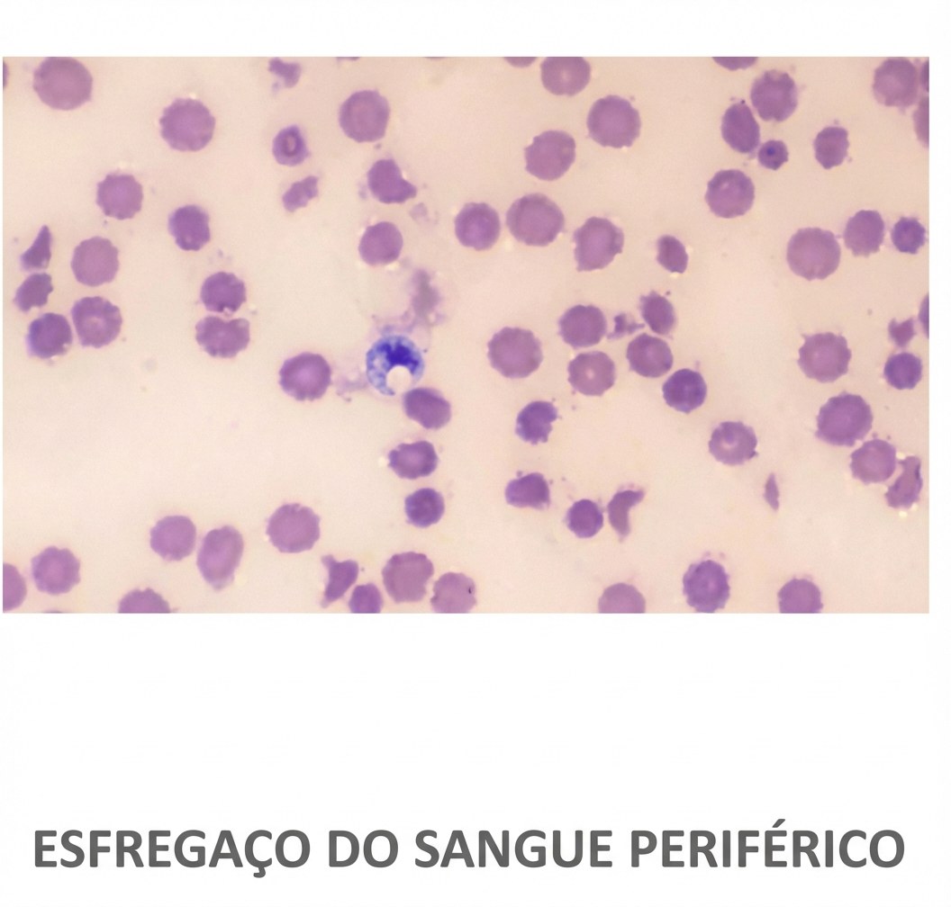 Imagem da questão de Distúrbios Eritrocitários Adquiridos