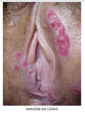 Imagem da questão de Infecções do trato genital