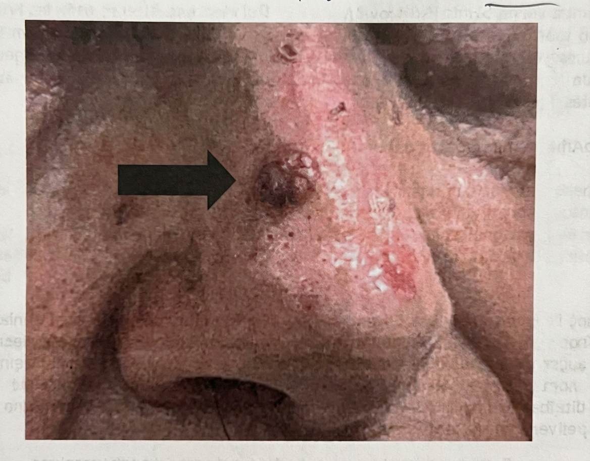 Imagem da questão de Neoplasias Cutâneas