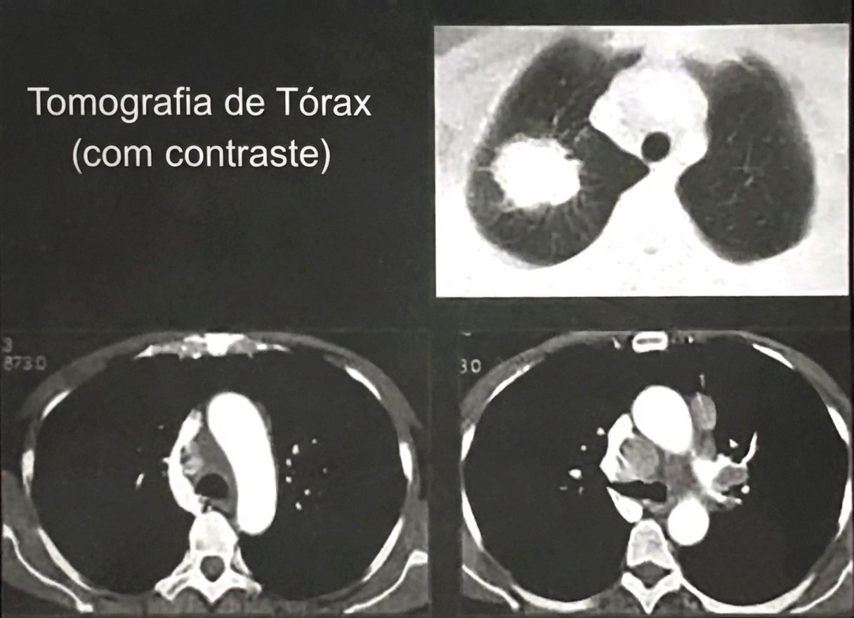 Imagem da questão de Oncologia Torácica