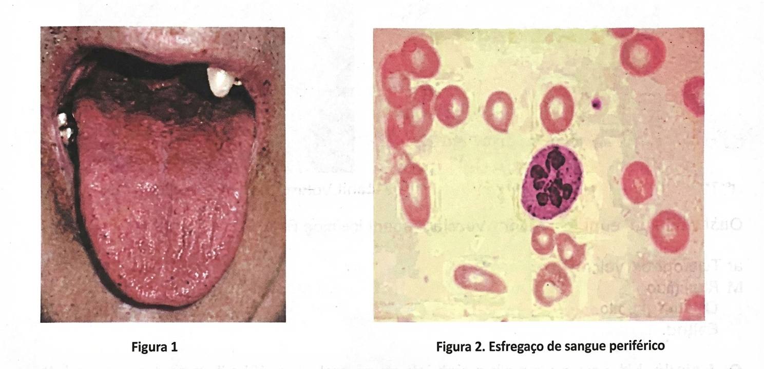 Imagem da questão de Distúrbios Eritrocitários Hereditários