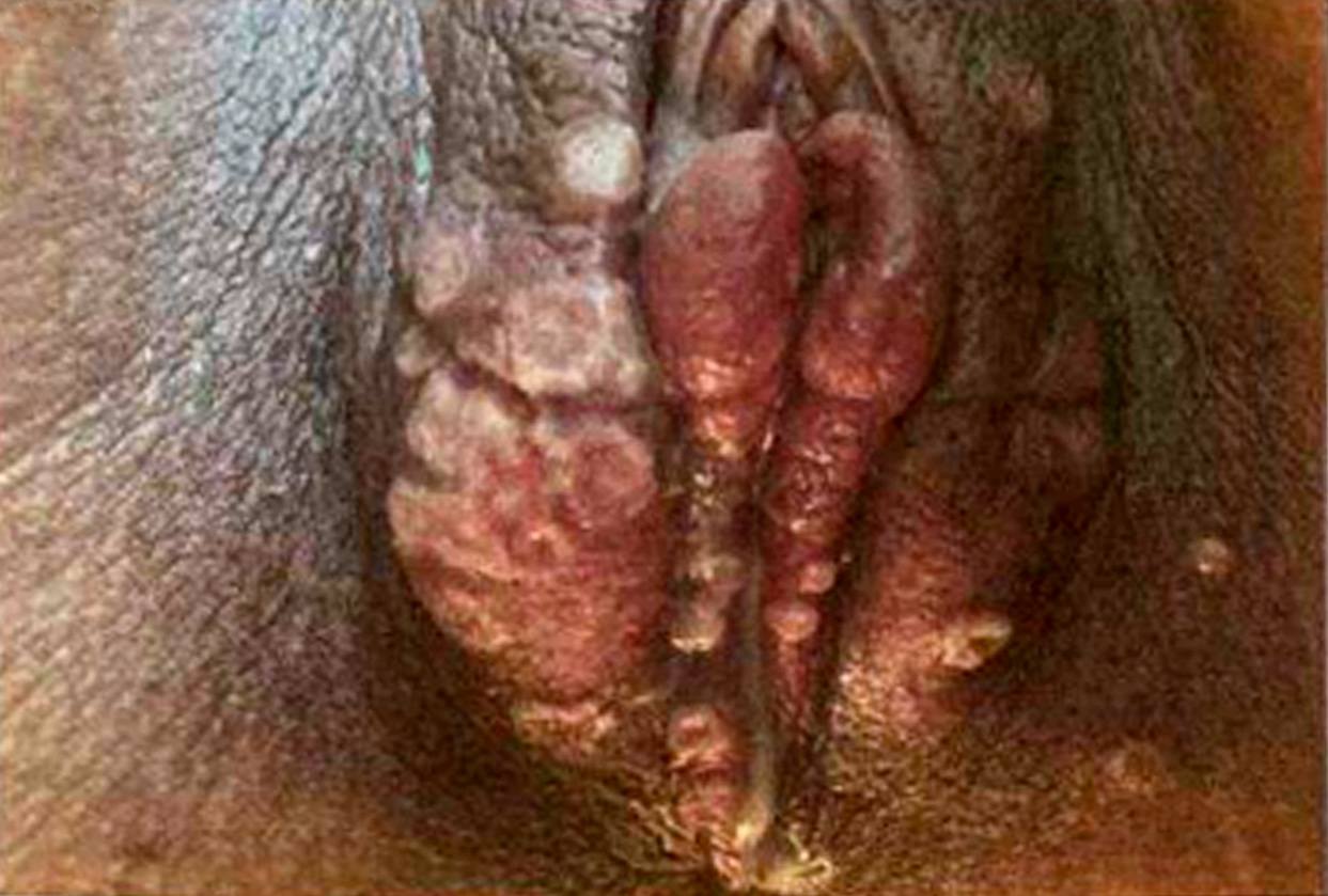 Imagem da questão de Infecções do trato genital