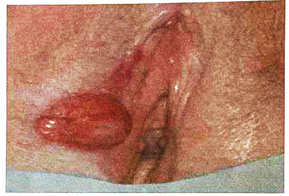 Imagem da questão de Câncer vulvar