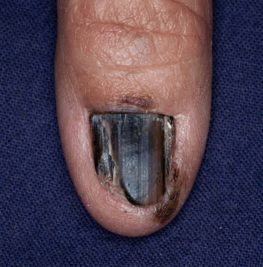 Imagem da questão de Neoplasias Cutâneas