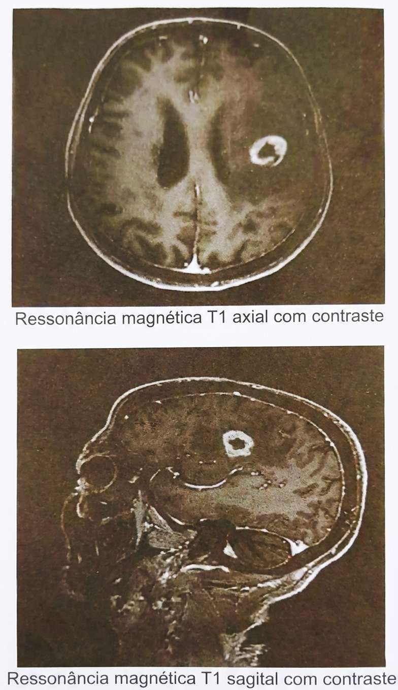 Imagem da questão de Neuro-oncologia