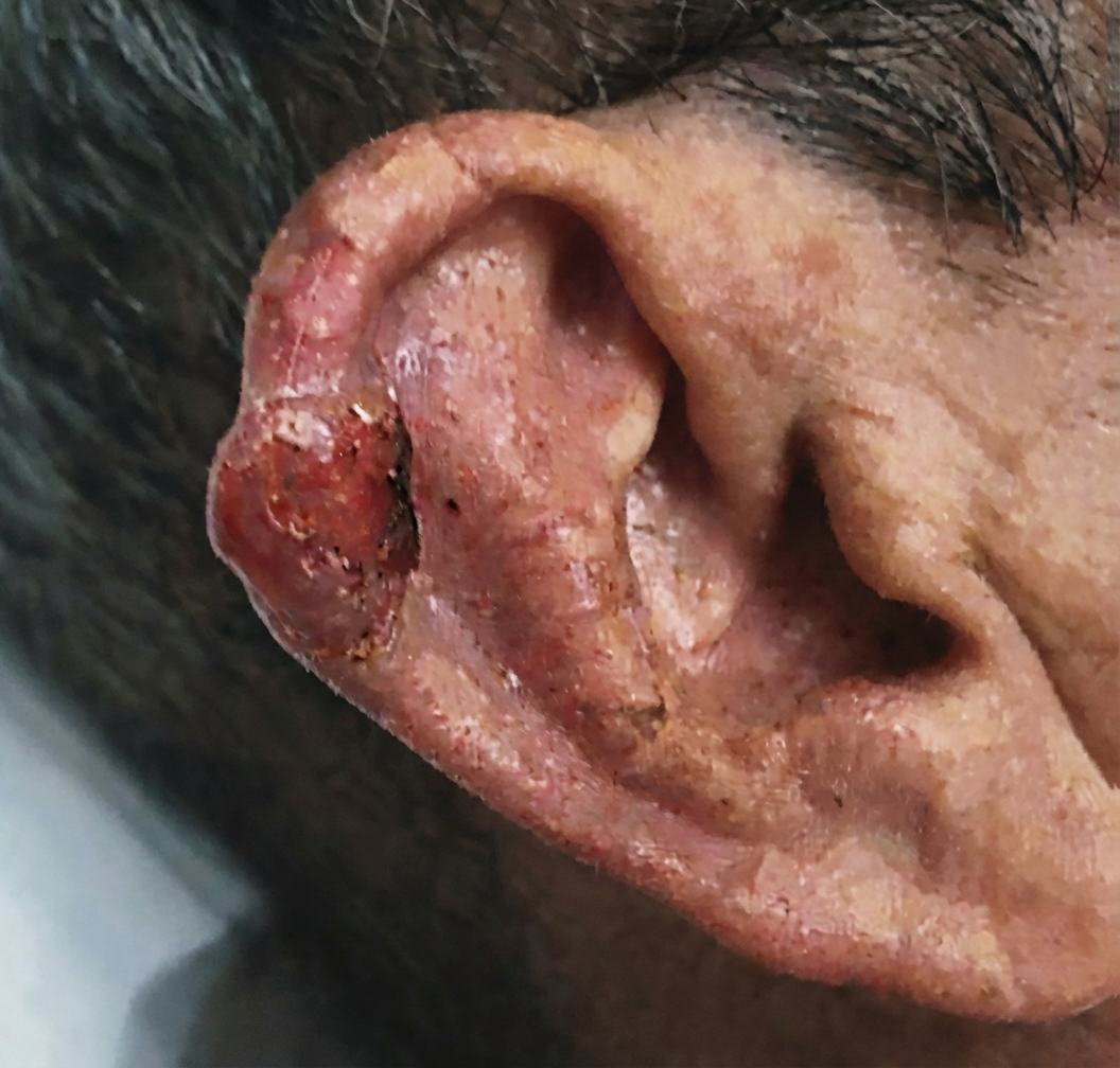 Imagem da questão de Neoplasias Cutâneas
