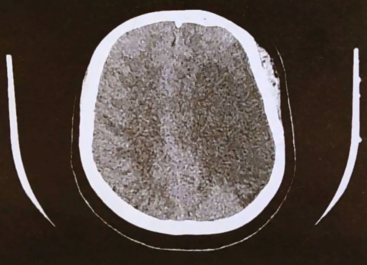 Imagem da questão de Doenças Cerebrovasculares