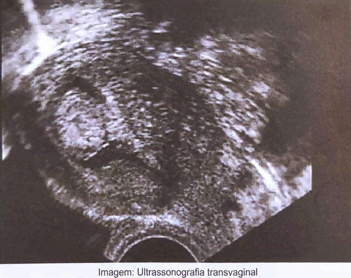 Imagem da questão de Sangramento uterino anormal