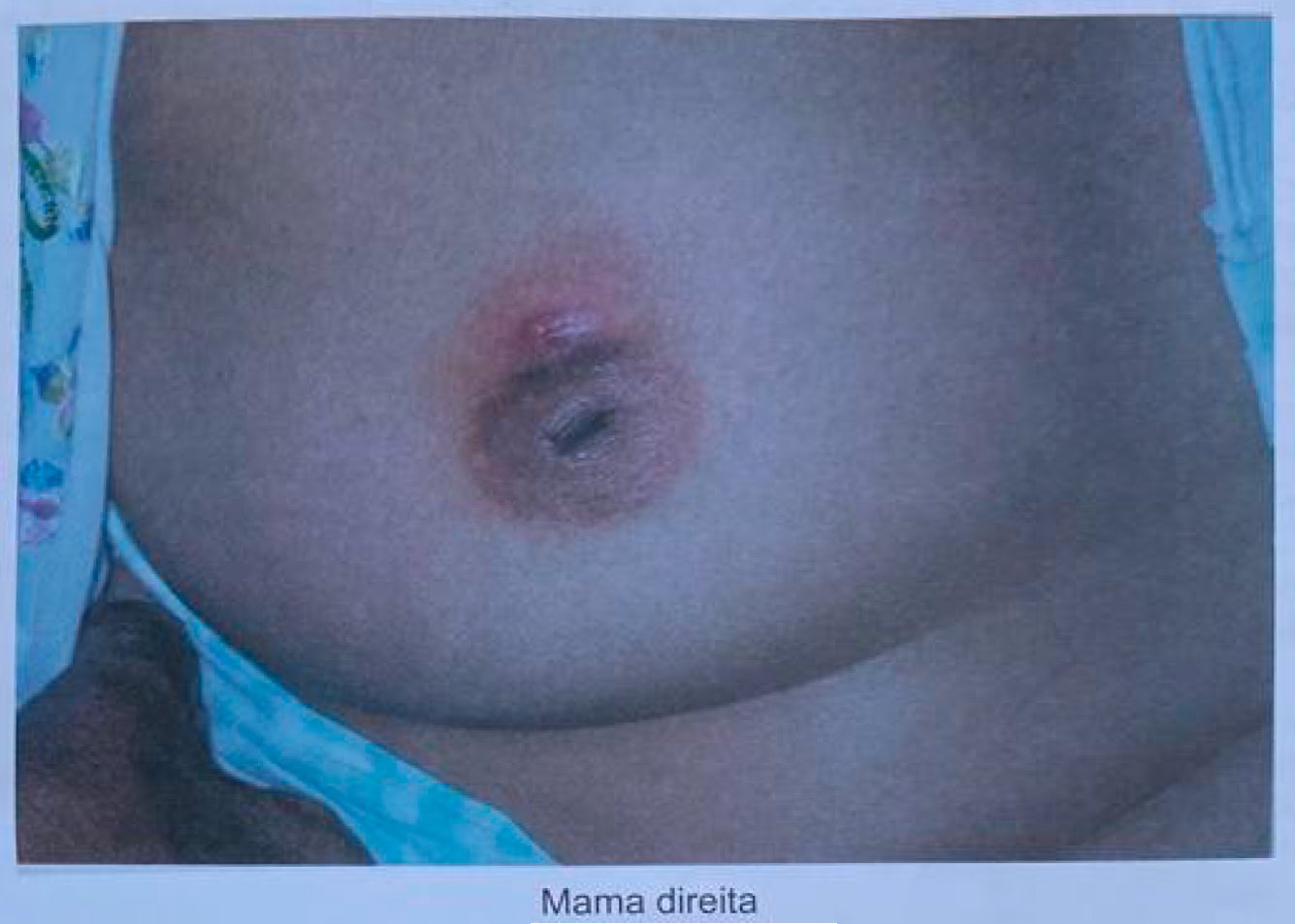 Imagem da questão de Alterações mamárias benignas