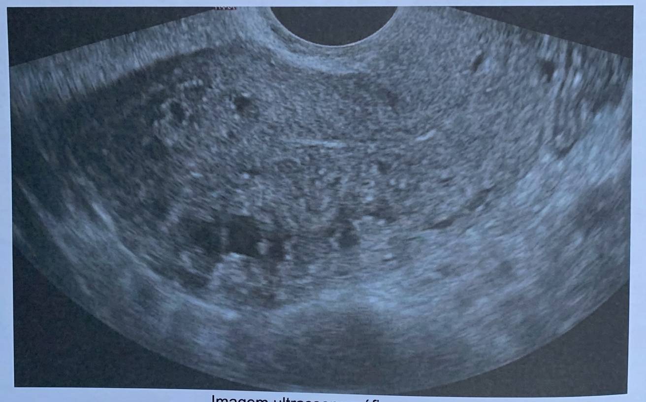 Imagem da questão de Sangramento uterino anormal
