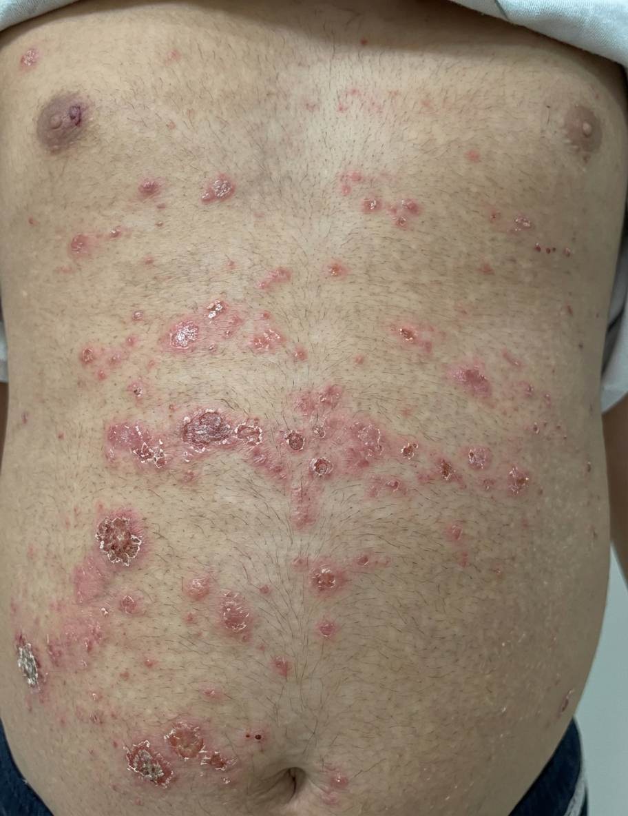 Imagem da questão de Infecções Cutâneas