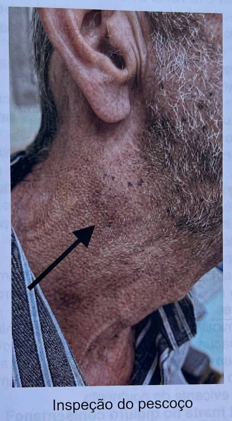 Imagem da questão de Oncologia Oral e Maxilofacial