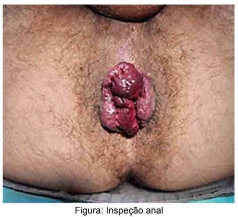 Imagem da questão de Coloproctologia