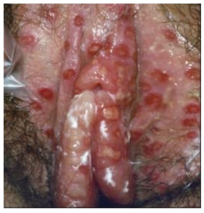 Imagem da questão de Infecções do trato genital