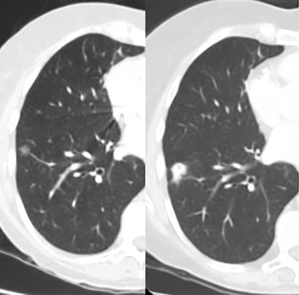 Imagem da questão de Oncologia Torácica
