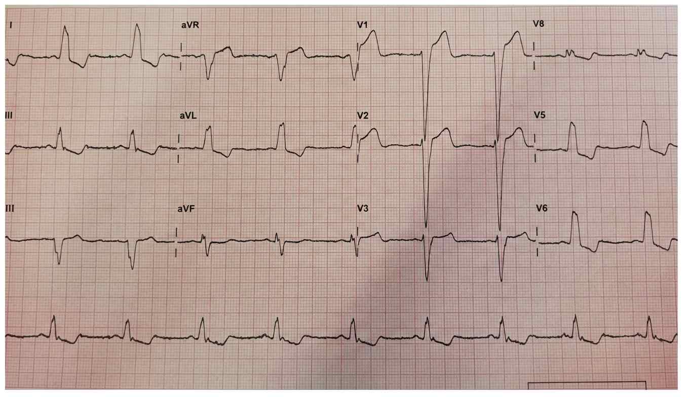 Imagem da questão de Eletrocardiograma (ECG)