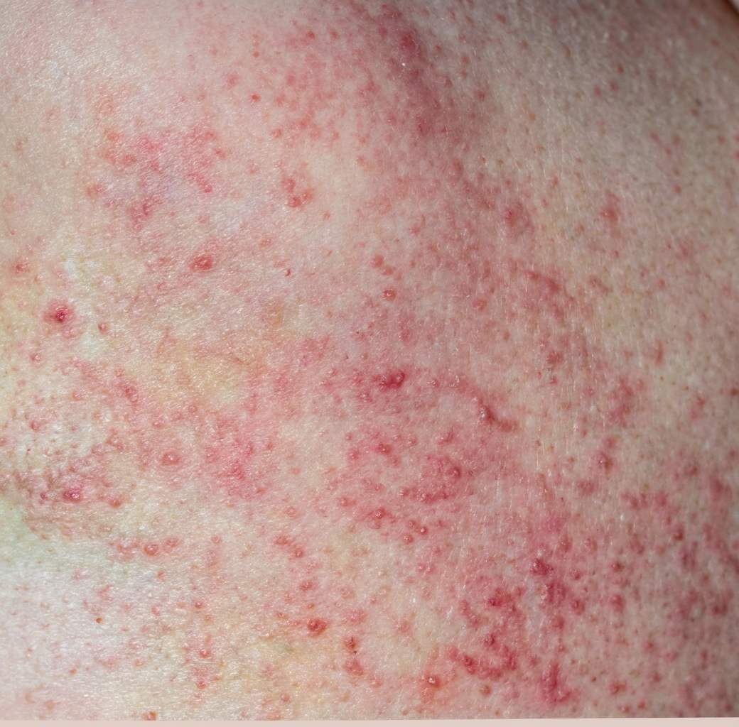 Imagem da questão de Distúrbios Plaquetários