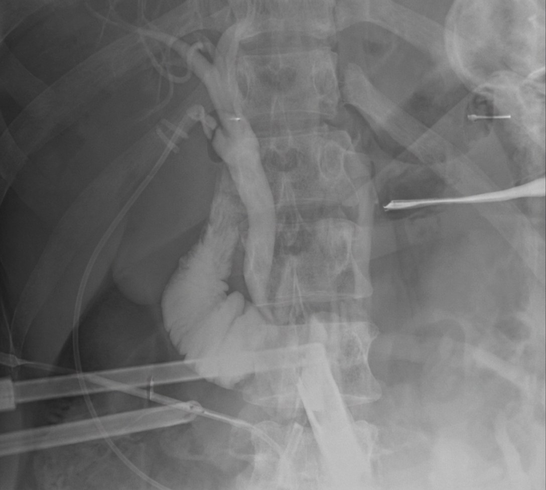 Imagem da questão de Pancreatobiliar