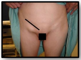 Imagem da questão de Hérnias da parede abdominal