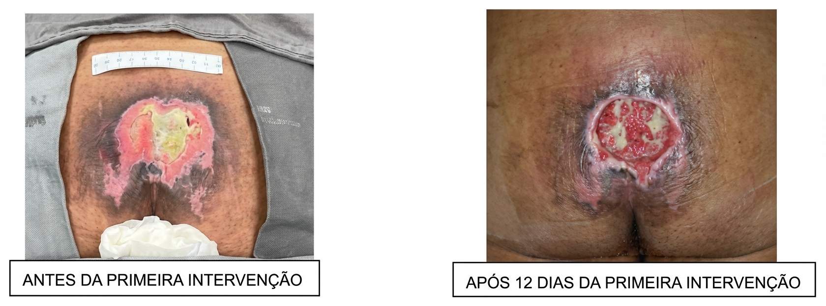 Imagem da questão de Úlceras por Pressão