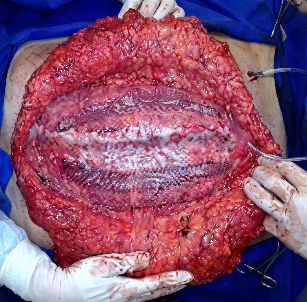Imagem da questão de Hérnias da parede abdominal