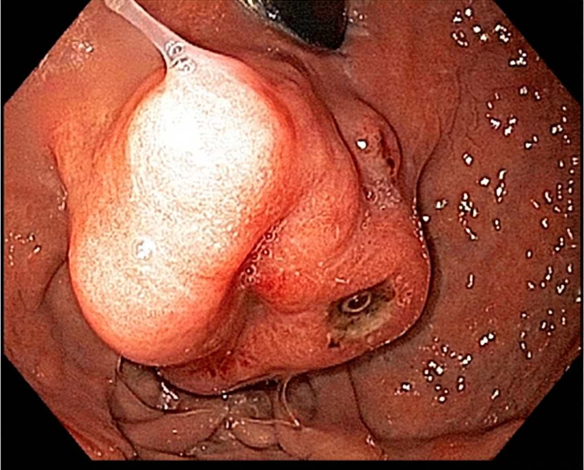 Imagem da questão de Cirurgia Gástrica
