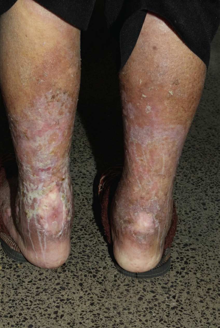 Imagem da questão de Insuficiência venosa crônica