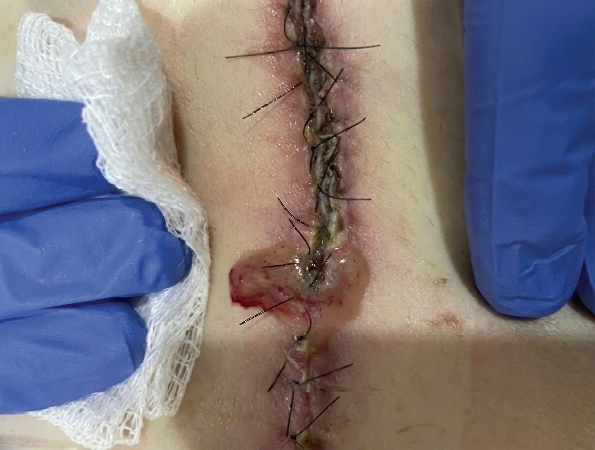 Imagem da questão de Hérnias da parede abdominal