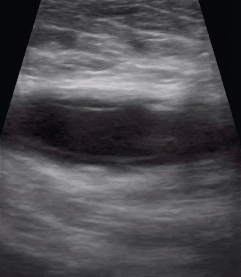 Imagem da questão de Hérnias da parede abdominal