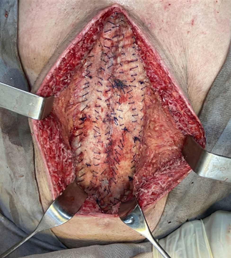 Imagem da questão de Hérnias da parede abdominal