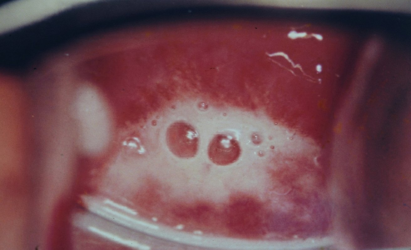 Imagem da questão de Infecções do trato genital