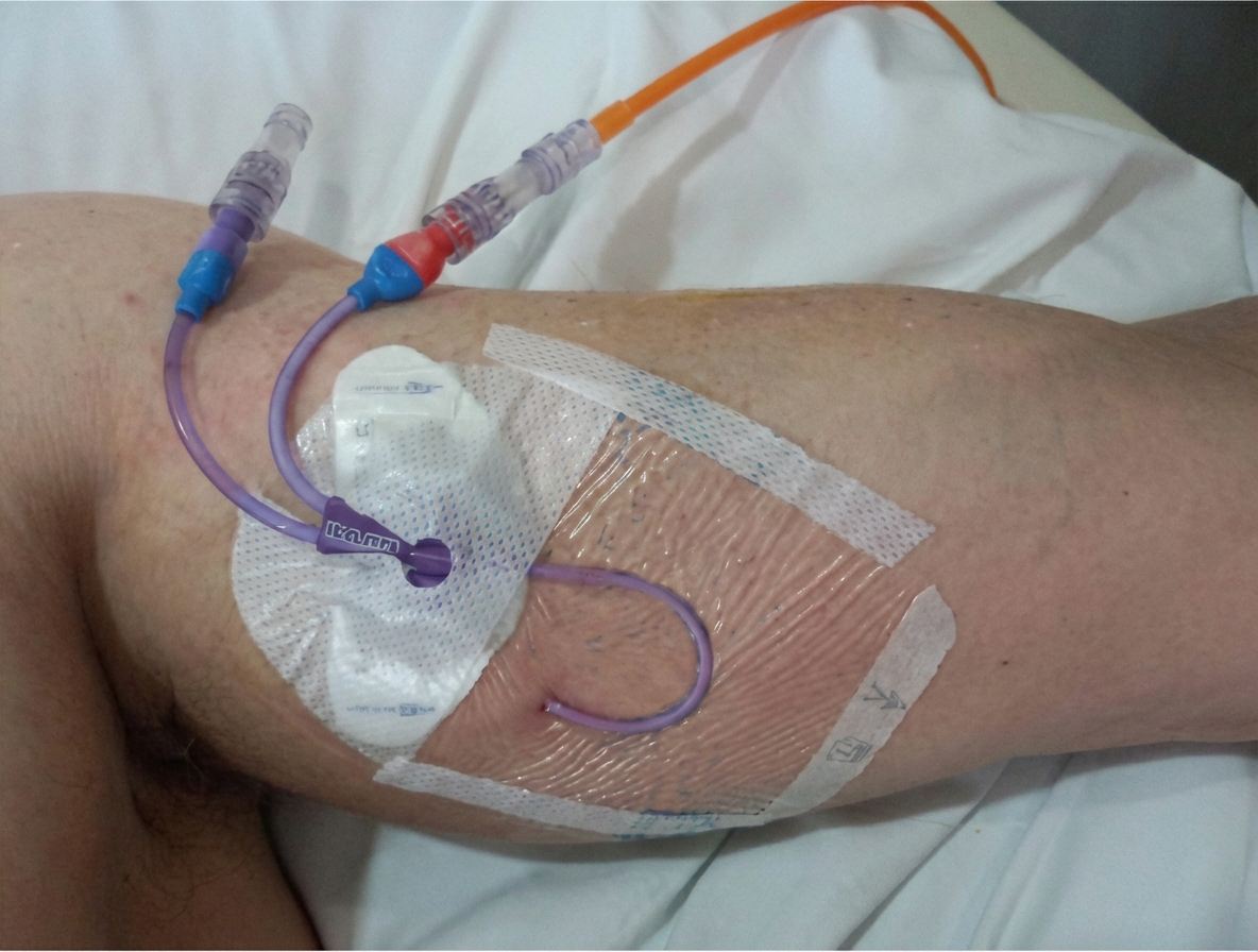 Imagem da questão de Acessos Vasculares