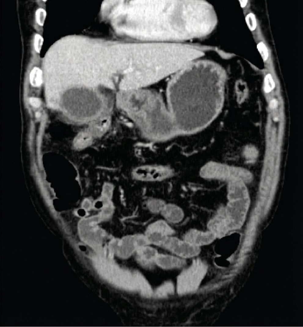 Imagem da questão de Pancreatobiliar