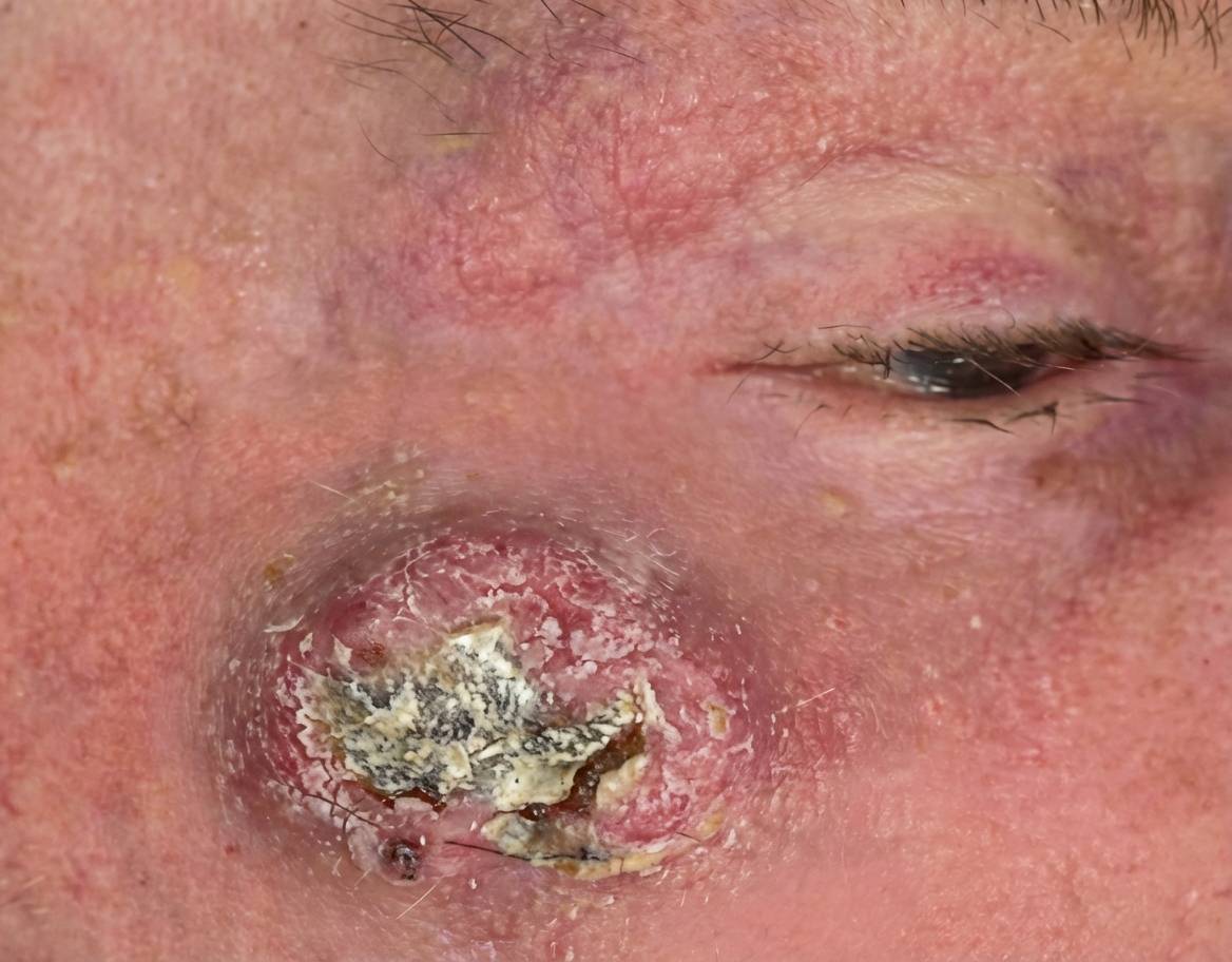 Imagem da questão de Neoplasias Cutâneas