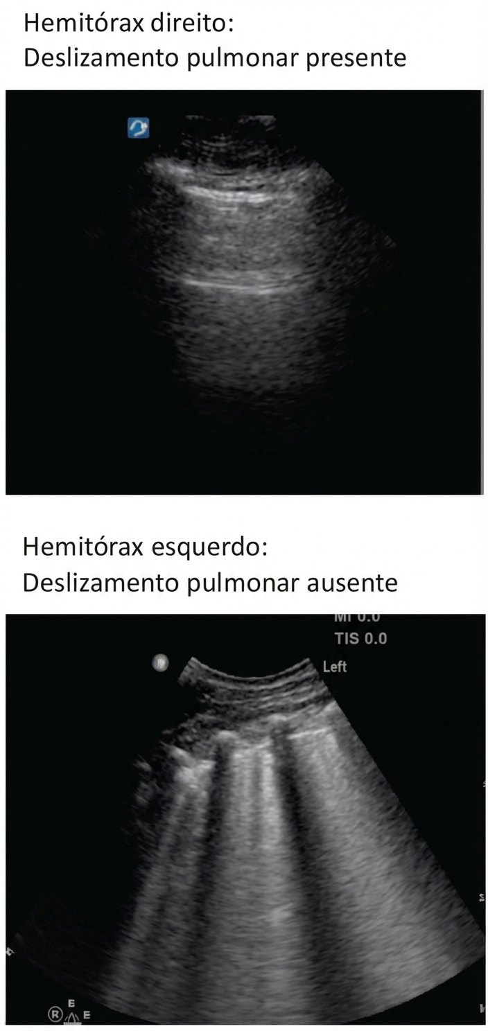 Imagem da questão de Doenças da Pleura e Mediastino
