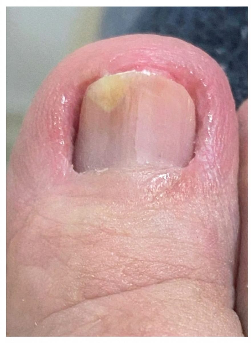 Imagem da questão de Infecções Cutâneas