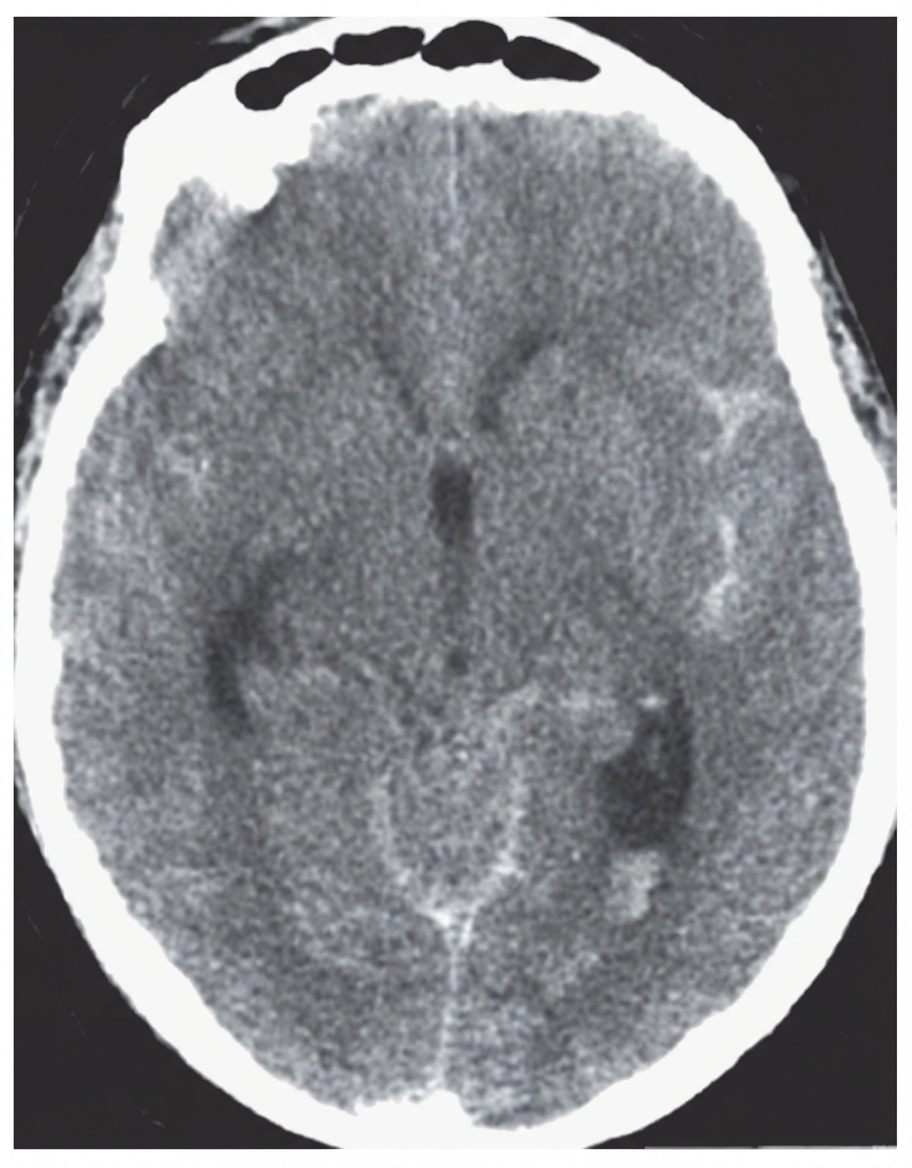 Imagem da questão de Doenças Cerebrovasculares