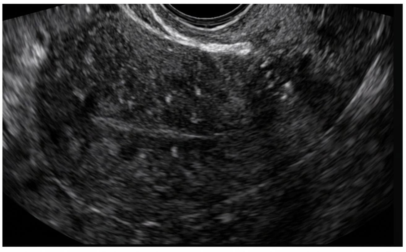 Imagem da questão de Sangramento uterino anormal
