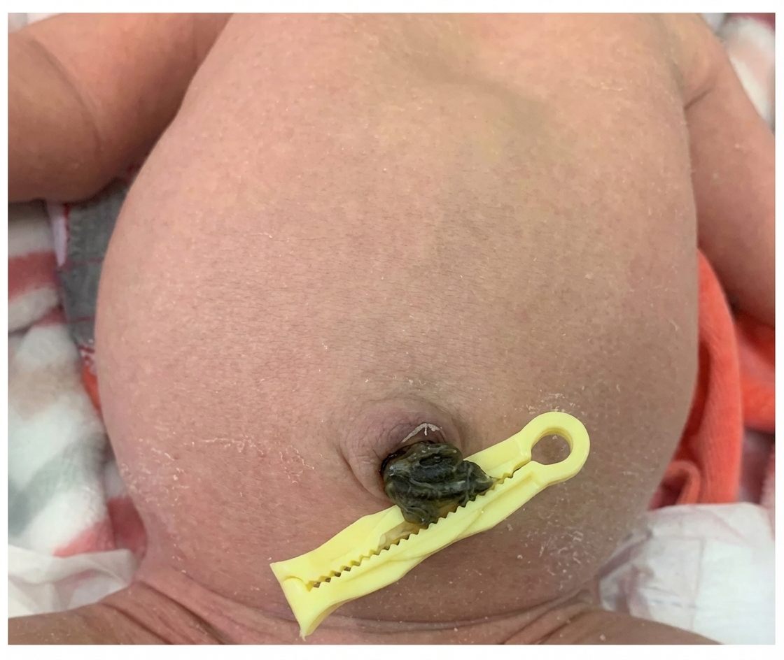 Imagem da questão de Hérnias da parede abdominal