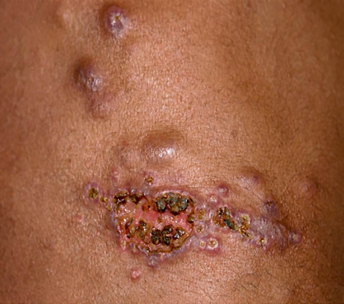 Imagem da questão de Infecções Cutâneas