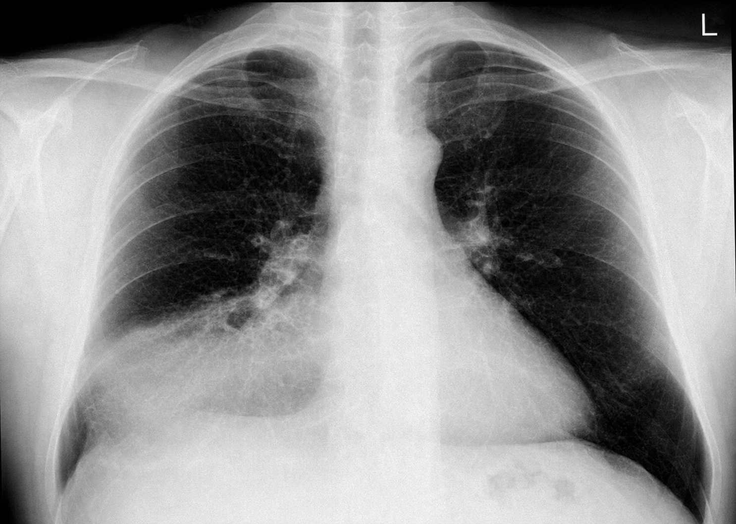 Imagem da questão de Pneumonia